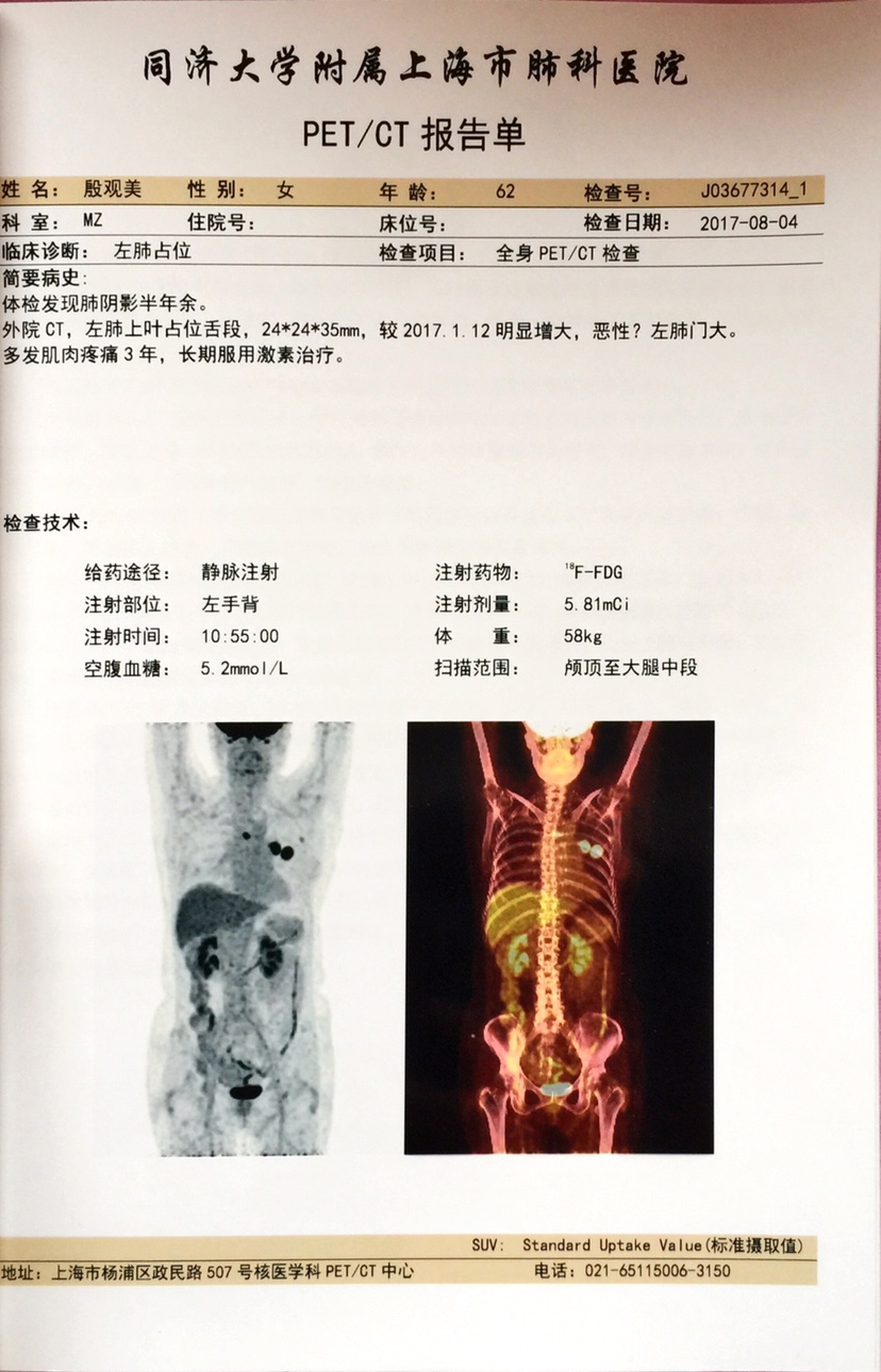 pet/ct                            检查结果:左肺上叶mt,合并左肺门