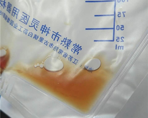 求助 肺癌胸积水有治愈的例子吗