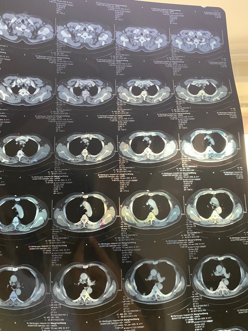 肺癌胸片图图片